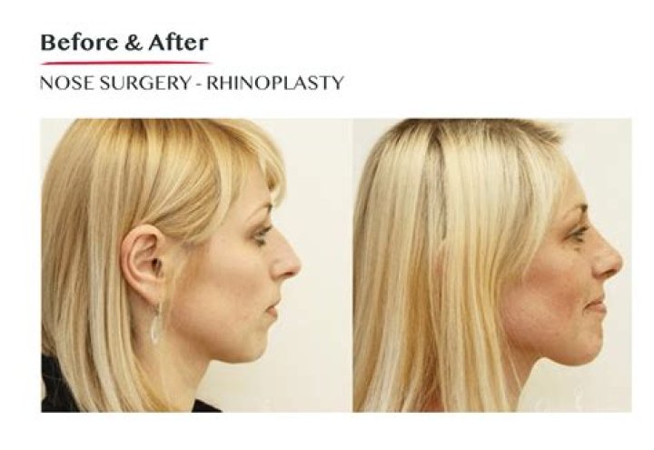Celine Dion Nose Job Plastic Surgery Before and After ·