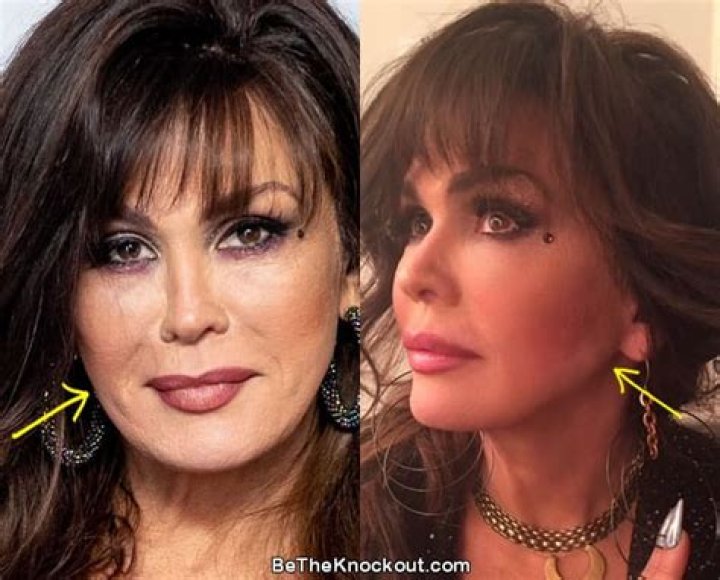 Marie Osmond Without Makeup Look: Plastic Surgery Before And After